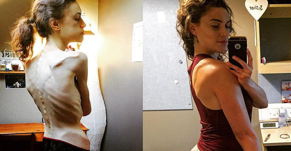 Duras Imágenes Del Antes Y Después De Una Sobreviviente De Anorexia Instagram Le Salvó La Vida
